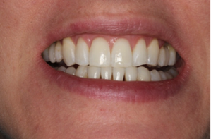 Patient After Treatment Teeth
