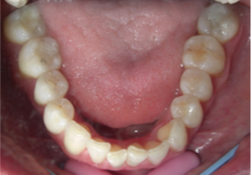 Patient Before Teeth Treatment