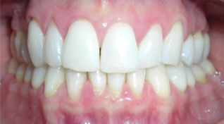 Patient Teeth Before Treatment